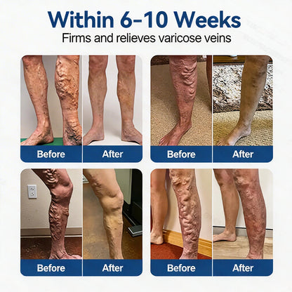𝐏𝐮𝐫𝐞𝐥𝐨𝐫𝐚® 𝐃𝐢𝐨𝐬𝐦𝐢𝐧 & 𝐀𝐞𝐬𝐜𝐢𝐧 𝐕𝐞𝐢𝐧 𝐂𝐨𝐧𝐭𝐨𝐮𝐫 𝐌𝐢𝐜𝐫𝐨𝐧𝐞𝐞𝐝𝐥𝐞 𝐏𝐚𝐭𝐜𝐡 🌿𝟕-𝐃𝐚𝐲 𝐕𝐢𝐬𝐢𝐛𝐥𝐞 𝐑𝐞𝐬𝐮𝐥𝐭𝐬 𝐟𝐨𝐫 𝐕𝐚𝐫𝐢𝐜𝐨𝐬𝐞 𝐕𝐞𝐢𝐧𝐬 - 𝐀𝐝𝐯𝐚𝐧𝐜𝐞𝐝 𝐇𝐞𝐫𝐛𝐚𝐥 𝐁𝐥𝐞𝐧𝐝 𝐓𝐚𝐫𝐠𝐞𝐭𝐬 𝐒𝐩𝐢𝐝𝐞𝐫 𝐕𝐞𝐢𝐧𝐬 & 𝐑𝐞𝐥𝐢𝐞𝐯𝐞𝐬 𝐇𝐞𝐚𝐯𝐲, 𝐓𝐢𝐫𝐞𝐝 𝐋𝐞𝐠𝐬🦵