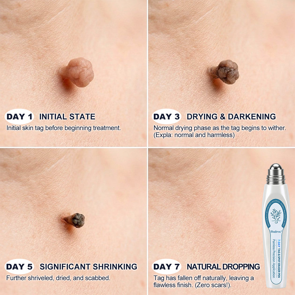 Hudros® 7-𝐷𝑎𝑦 𝗧𝐚𝐠 & 𝗦𝗽𝐨𝐭 𝐄𝐫𝒂𝒔𝒆𝒓(Zero Pain, Zero 𝐒𝐜𝐚𝒓𝒔 Rollerball)💪