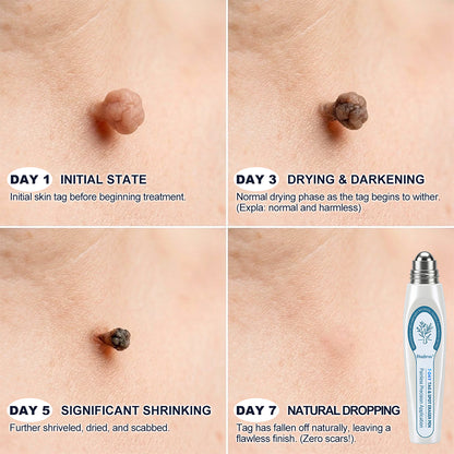Hudros® 7-𝐷𝑎𝑦 𝗧𝐚𝐠 & 𝗦𝗽𝐨𝐭 𝐄𝐫𝒂𝒔𝒆𝒓(Zero Pain, Zero 𝐒𝐜𝐚𝒓𝒔 Rollerball)💪